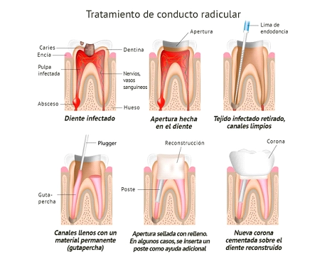 Diagrama de Tratamiento de Conducto Radicular